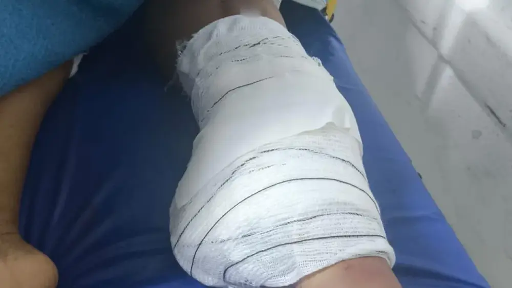 Diarista tem perna amputada após acidente; família busca motorista